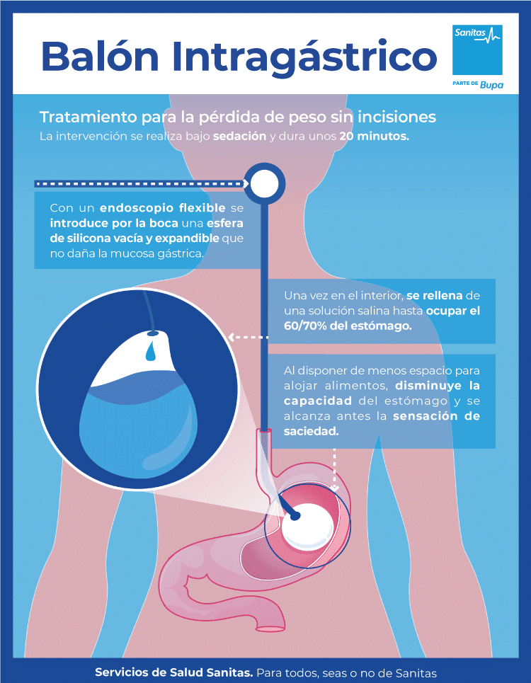 balon intragastrico tenerife